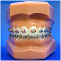 Metallic Braces