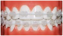 Ceramic Braces