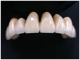 CAD-CAM Crowns/Bridges (Computerized Manufactured Crowns/Bridges)