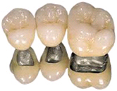 PFM Crowns (Porcelain/Ceramic Fused to Metal)