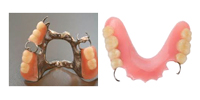Partial Dentures