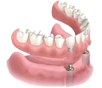 Implant Supported Dentures