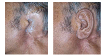 Ear prosthesis