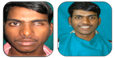Eye prosthesis