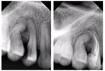 Root Canal Treatment